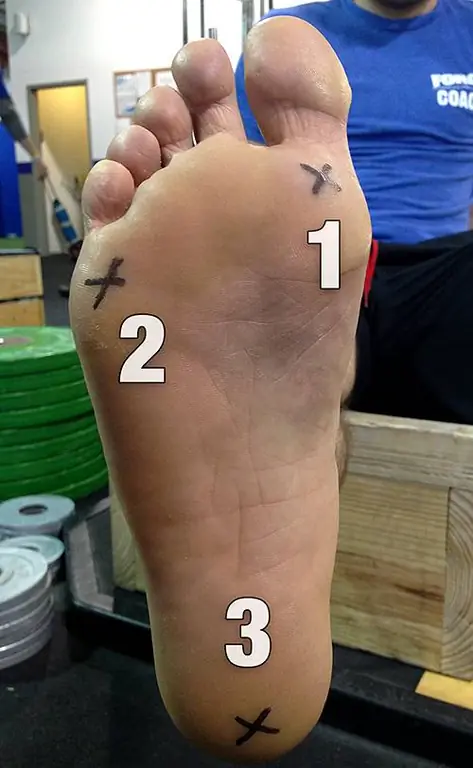 Плоскостопие