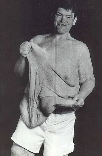 Растянутая, поврежденная кожа