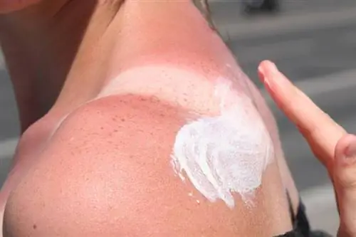 Домашние средства, лекарства & Кремы: как быстро избавиться от солнечных ожогов