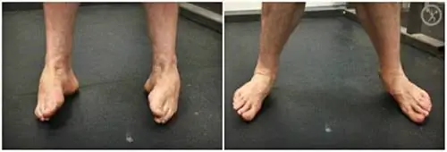 травма голеностопного сустава, подвижность голеностопного сустава, деформации голеностопного сустава, вывихи голеностопного сустава, заживление голеностопного сустава