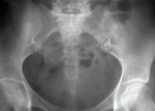 триада спортсменок, кроссфит, кости