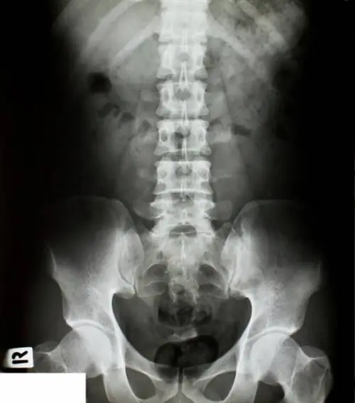 Искусственный диск может спасти спортсменов с травмами позвоночника