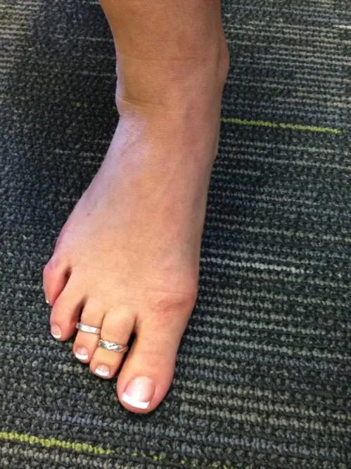 плохой присед, плохая механика, механика тела, как приседать, терапия приседаниями