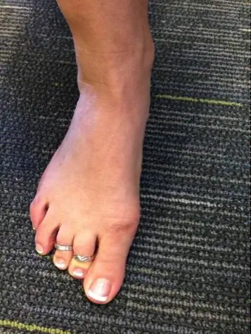 плохой присед, плохая механика, механика тела, как приседать, терапия приседаниями