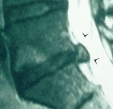 грыжа межпозвоночного диска, грыжа межпозвоночного диска, выпячивание диска, заживление выпячивания диска, заживление спины