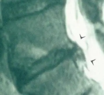 грыжа межпозвоночного диска, грыжа межпозвоночного диска, выпячивание диска, заживление выпячивания диска, заживление спины