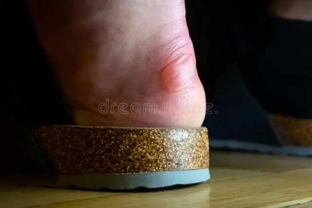 Что вызывает жирную пятку?